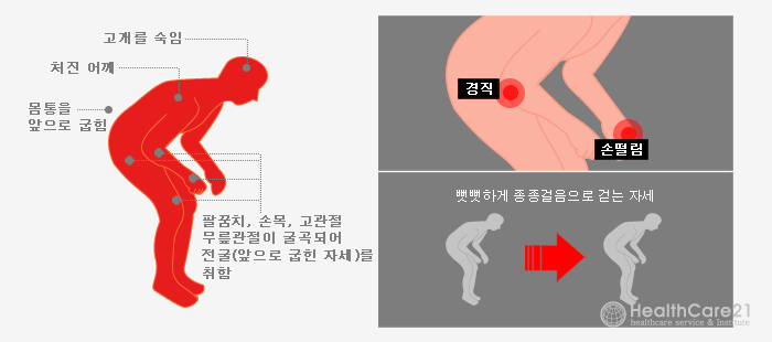 파킨슨병